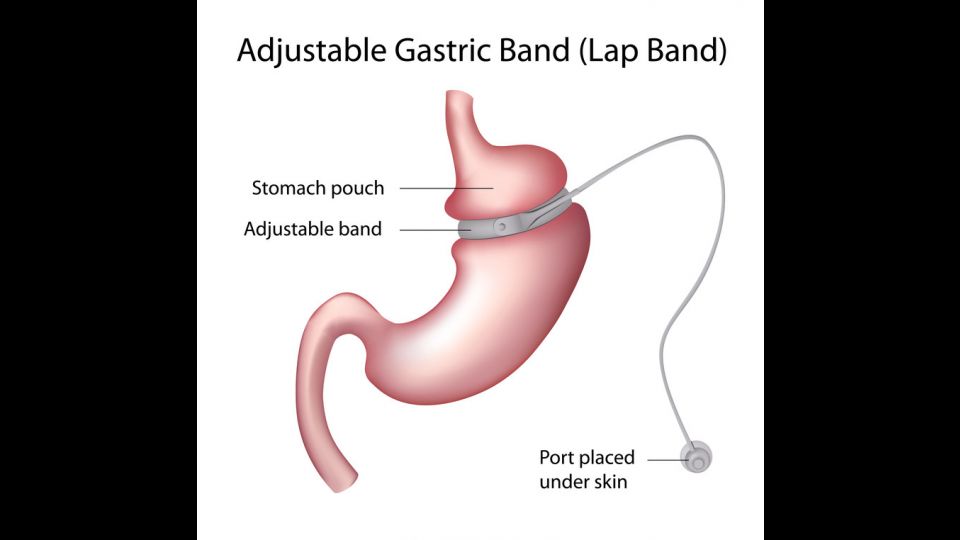 ANNEAU GASTRIQUE PARIS | OBESITE CHIRURGIE PARIS