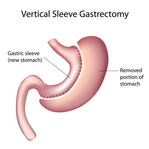 Sleeve Gastrectomy Paris | Dr. Bruto RANDONE | Digestive and Bariatric Surgeon | OBESITY SURGERY PARIS