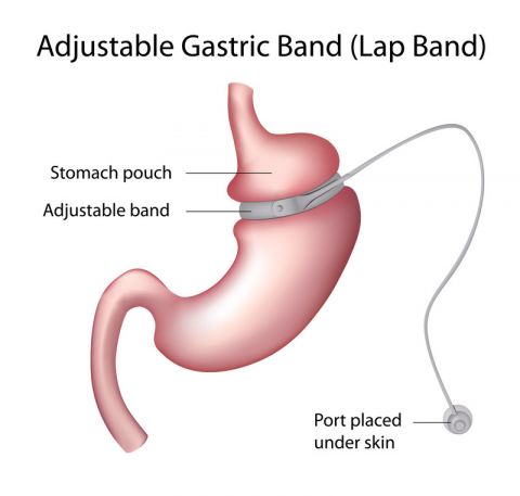 Gastric Band Paris | France Dr. Bruto Randone Digestive and Bariatric Surgeon | OBESITY SURGERY PARIS