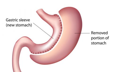 Sleeve Gastrectomy Paris | France | Dr. Bruto Randone | Digestive and Bariatric Surgeon | OBESITY SURGERY PARIS