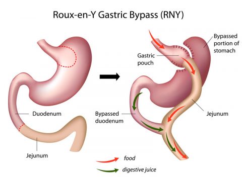 ByPass Gastrique | Dr. Bruto RANDONE